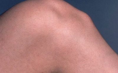 Apofisite tibiale Physiotherapy | Apofisite tibiale