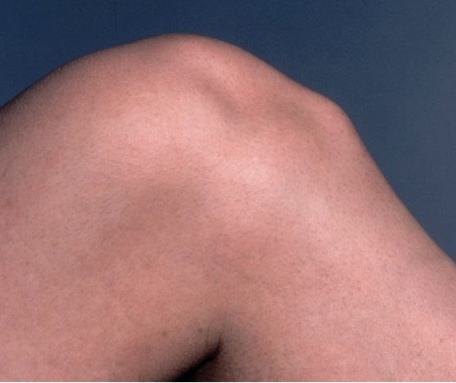 Physiotherapy | Apofisite tibiale