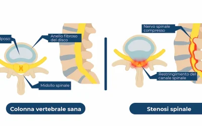 Stenosi lombare: cos’è e quali sono i possibili trattamenti Physiotherapy | Stenosi lombare: cos’è e quali sono i possibili trattamenti