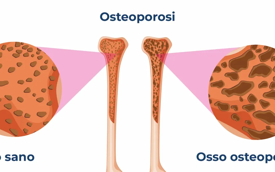 Physiotherapy | Allenare la forza può giocare un ruolo importante sulla cura e prevenzione dell’osteoporosi nelle donne in menopausa?