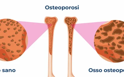 Allenare la forza può giocare un ruolo importante sulla cura e prevenzione dell’osteoporosi nelle donne in menopausa? Physiotherapy | Allenare la forza può giocare un ruolo importante sulla cura e prevenzione dell’osteoporosi nelle donne in menopausa?