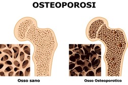 Allenare la forza può giocare un ruolo importante sulla cura e prevenzione dell’osteoporosi nelle donne in menopausa?