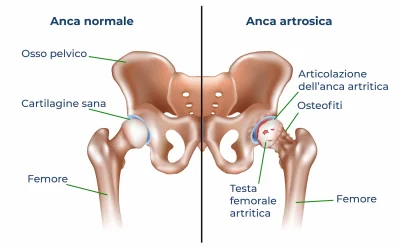 Artrosi dell’anca