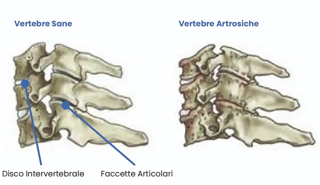 Physiotherapy | Artrosi cervicale sintomi e rimedi