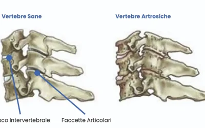 Artrosi cervicale sintomi e rimedi Physiotherapy | Artrosi cervicale sintomi e rimedi