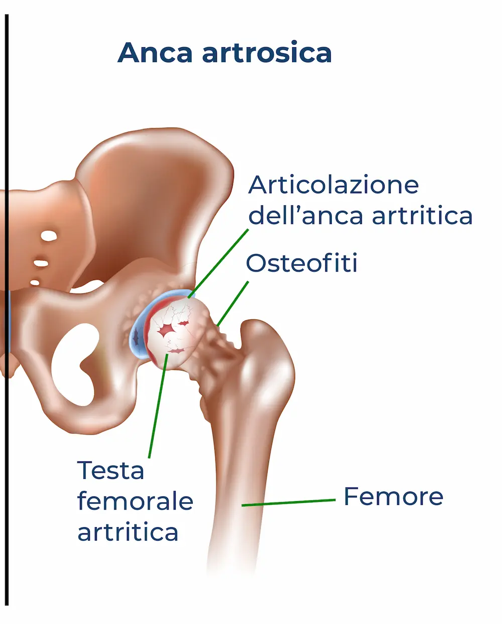 Artrosi dell'anca osteofiti-anca